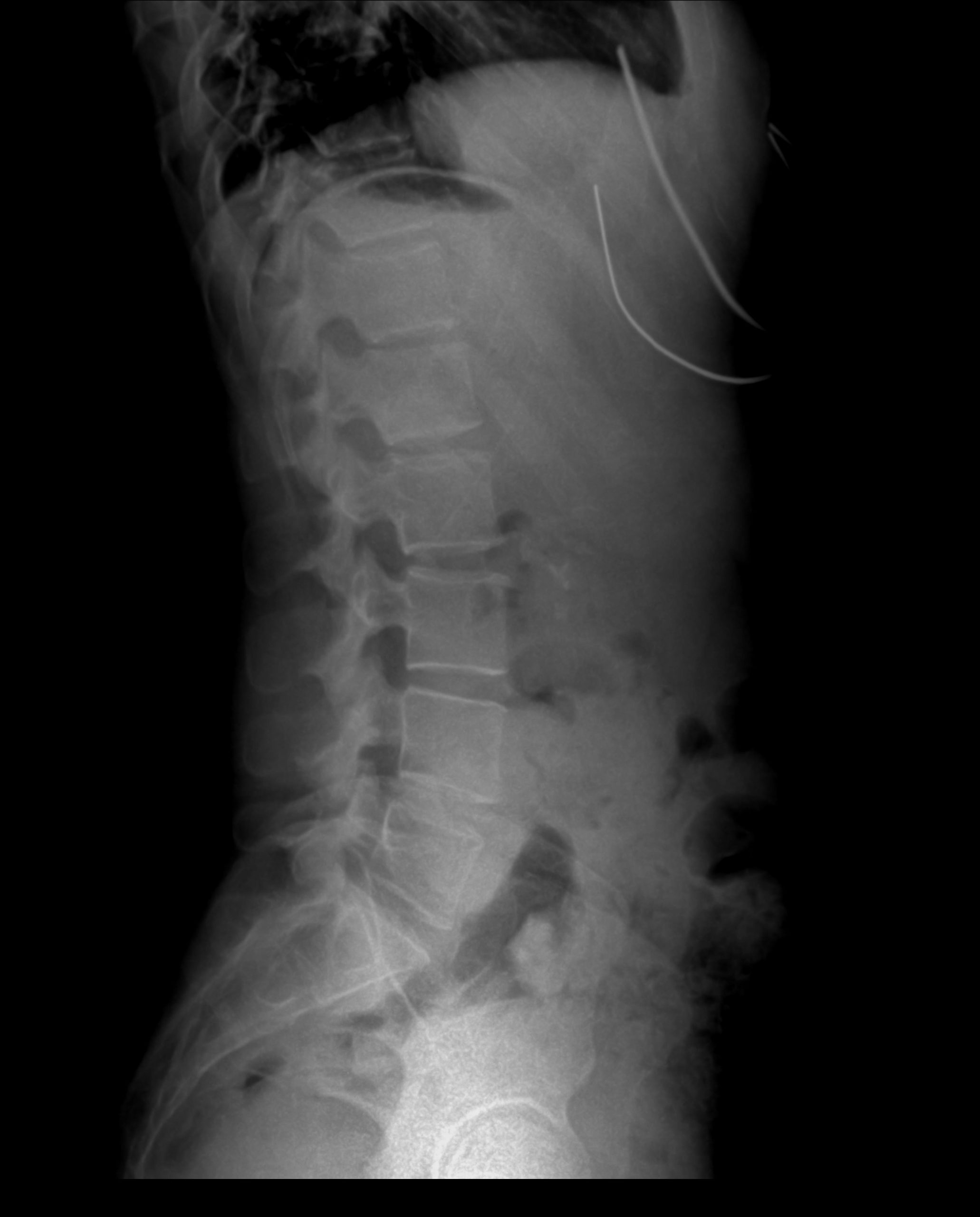 Dual view spinal X-ray preview